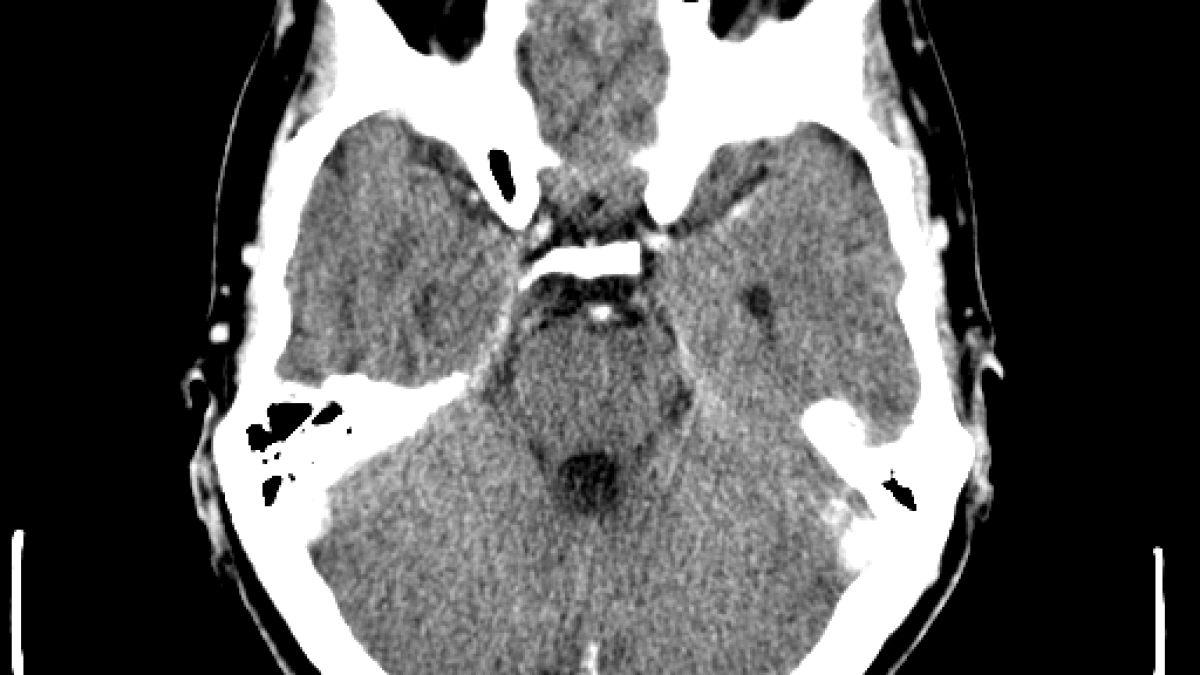 computed_tomography_of_brain.png computed_tomography_of_brain.png