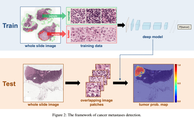 IA cancer IA cancer