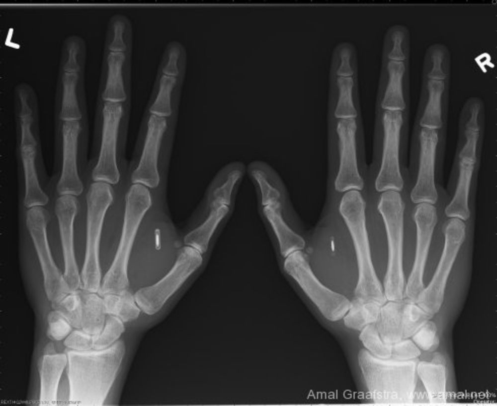 Radio d'une puce RFID implantée / Amal Graafstra Radio d'une puce RFID implantée / Amal Graafstra