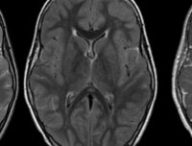 mri