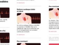 Résultats possibles avec un électrocardiogramme // Source : Numerama