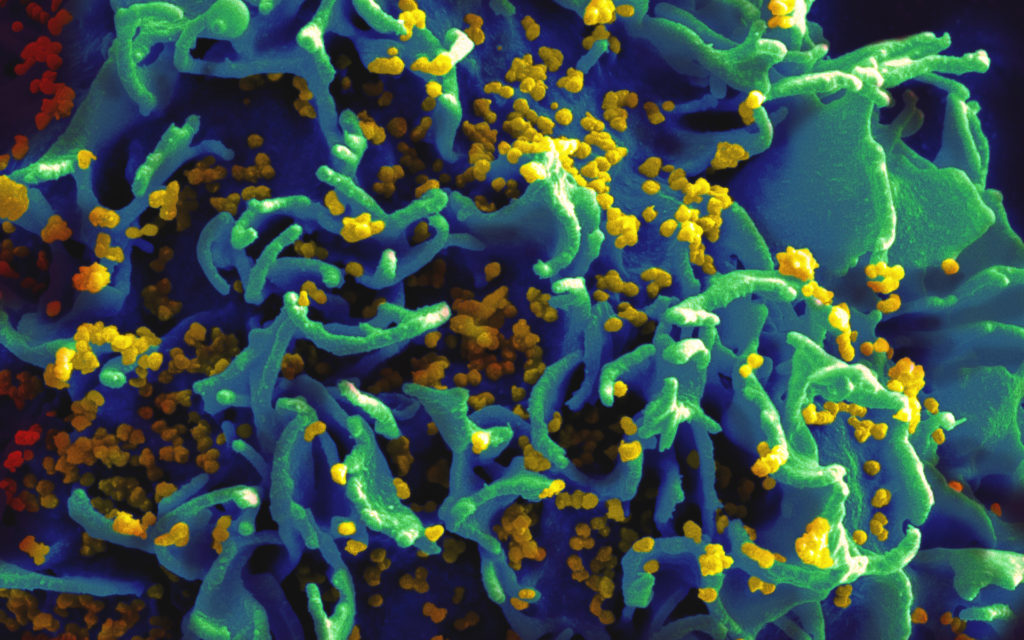 Une cellule infectée par le VIH. // Source : National Institutes of Health Une cellule infectée par le VIH. // Source : National Institutes of Health