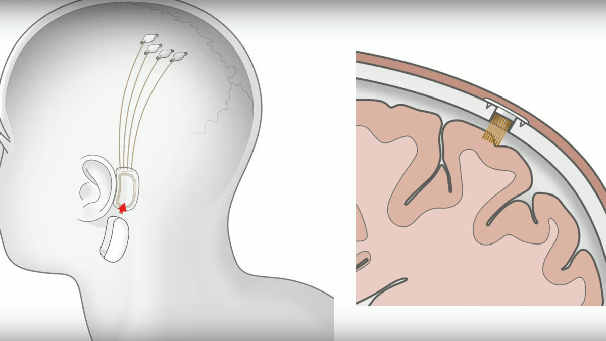 Capture Youtube / Neuralink Capture Youtube / Neuralink