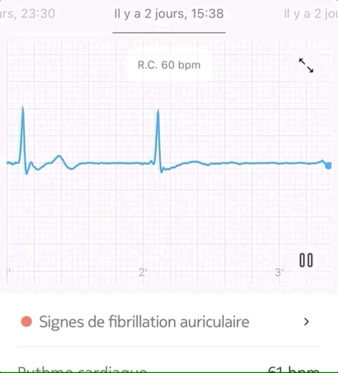 ecg