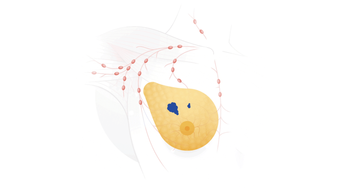Dépistage cancer du sein // Source : Google Dépistage cancer du sein // Source : Google