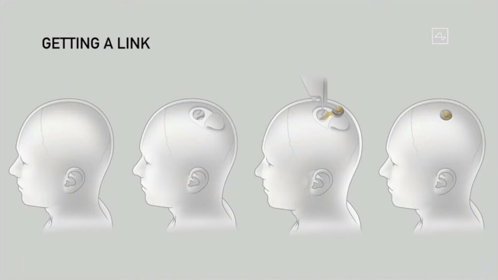 La chirurgie pour insérer la puce de Neuralink se veut peu invasive, d'après les descriptions fournies par Elon Musk. // Source : Neuralink La chirurgie pour insérer la puce de Neuralink se veut peu invasive, d'après les descriptions fournies par Elon Musk. // Source : Neuralink