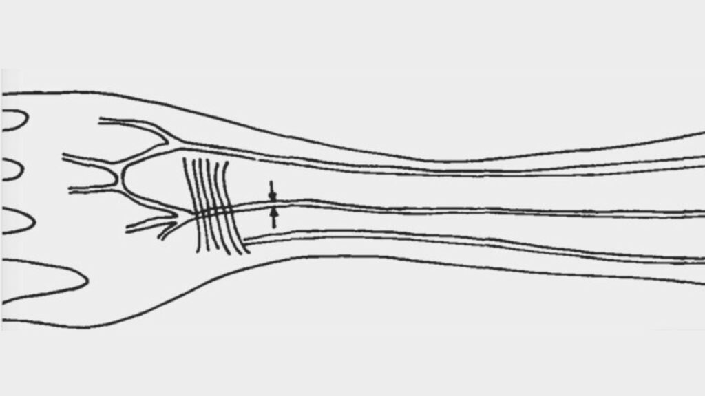 Au milieu, désignée par les deux petites flèches, l'artère médiane (car au milieu des deux autres artères). // Source : Pr Maciej Henneberg / Flinders University Au milieu, désignée par les deux petites flèches, l'artère médiane (car au milieu des deux autres artères). // Source : Pr Maciej Henneberg / Flinders University