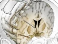 Implant cérébral personnalisé contre la dépression résistante. // Source : UC San Francisco (UCSF)