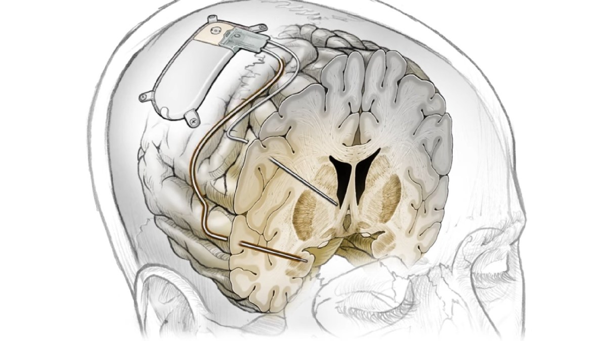 Implant cérébral personnalisé contre la dépression résistante. // Source : UC San Francisco (UCSF) Implant cérébral personnalisé contre la dépression résistante. // Source : UC San Francisco (UCSF)