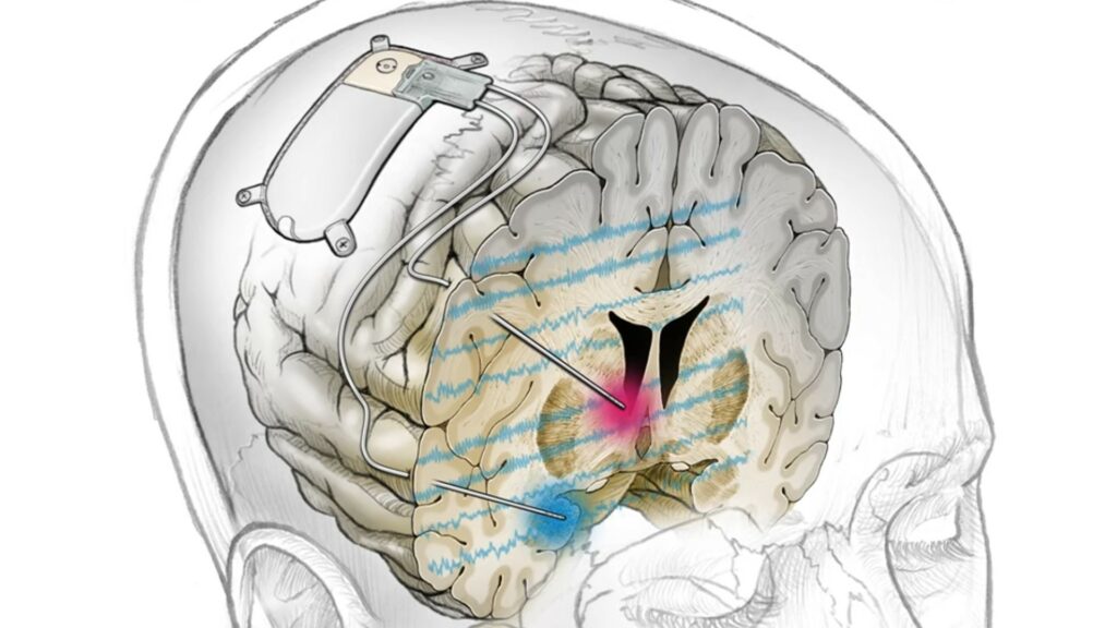 L'implant déclenche une stimulation cérébrale personnalisée lorsque les biomarqueurs liés à la dépression du patient se déclenchent. // Source : UC San Francisco (UCSF) L'implant déclenche une stimulation cérébrale personnalisée lorsque les biomarqueurs liés à la dépression du patient se déclenchent. // Source : UC San Francisco (UCSF)