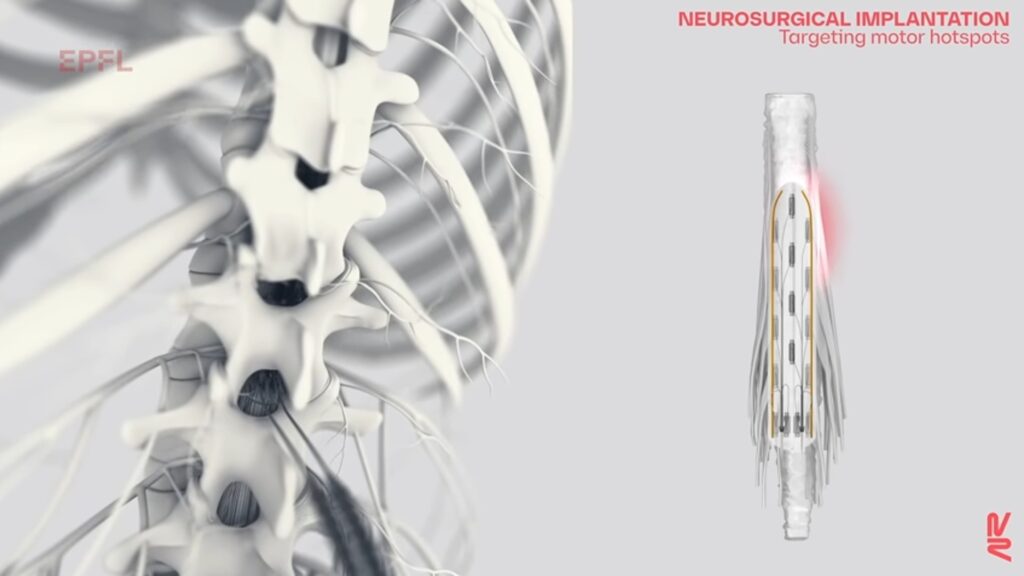 Les implants viennent réactiver des neurones spécifiques en fonction de la tâche. // Source : NeuroRestore Les implants viennent réactiver des neurones spécifiques en fonction de la tâche. // Source : NeuroRestore