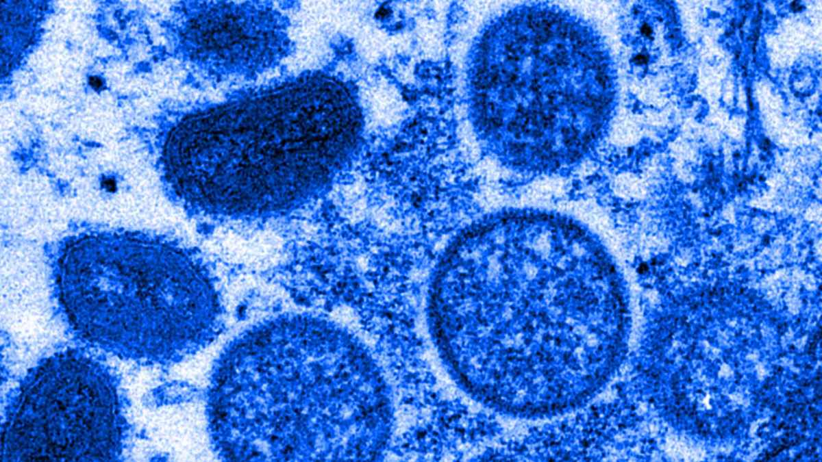 Micrographie électronique de particules de virus de la variole du singe isolés en 2003 aux États-Unis, dans des échantillons humains // Source : The Conversation / Cynthia S. Goldsmith, Russell Regner / CDC / AP Micrographie électronique de particules de virus de la variole du singe isolés en 2003 aux États-Unis, dans des échantillons humains // Source : The Conversation / Cynthia S. Goldsmith, Russell Regner / CDC / AP