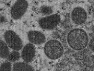Variole du singe (image modifiée) // Source : CDC Variole du singe (image modifiée) // Source : CDC