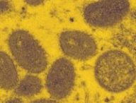 Variole du singe au microscope // Source : CDC Variole du singe au microscope // Source : CDC