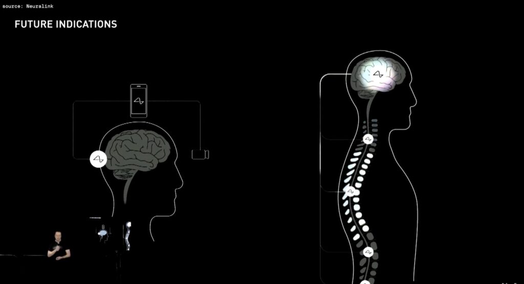Deux priorités de Neuralink // Source : YouTube/Neuralink/TheVerge Deux priorités de Neuralink // Source : YouTube/Neuralink/TheVerge