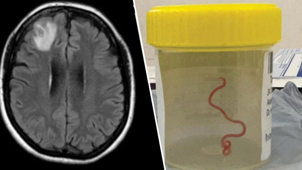 La lésion dans le cerveau, causée par le ver. À droite, le ver, dans un bocal, après extraction. // Source : Hossain et al., Emerging Infectious Diseases, 2023 La lésion dans le cerveau, causée par le ver. À droite, le ver, dans un bocal, après extraction. // Source : Hossain et al., Emerging Infectious Diseases, 2023