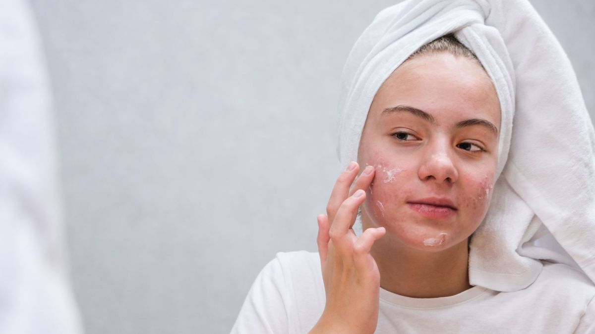 L'acné sur le visage provient d'une hypersécrétion de sébum. // Source : Canva L'acné sur le visage provient d'une hypersécrétion de sébum. // Source : Canva