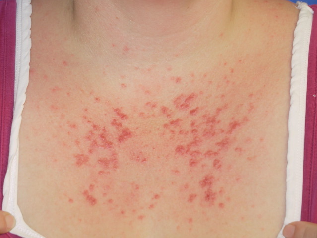 Polymorphic_Light_Eruption_on_the_chest Polymorphic_Light_Eruption_on_the_chest
