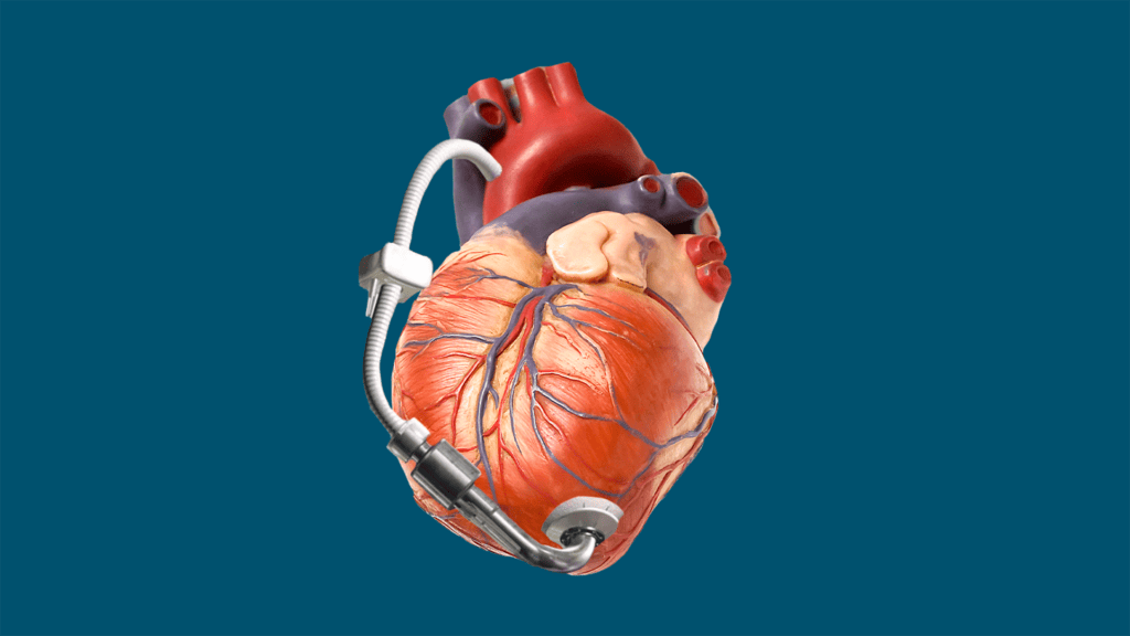 cœur muni d'une LVAD // Source : Montage Numerama - envato & ALiEM cœur muni d'une LVAD // Source : Montage Numerama - envato & ALiEM