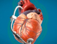 cœur muni d'une LVAD, stylisé // Source : Montage Numerama - envato & ALiEM cœur muni d'une LVAD, stylisé // Source : Montage Numerama - envato & ALiEM