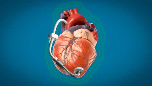 cœur muni d'une LVAD, stylisé // Source : Montage Numerama - envato & ALiEM cœur muni d'une LVAD, stylisé // Source : Montage Numerama - envato & ALiEM