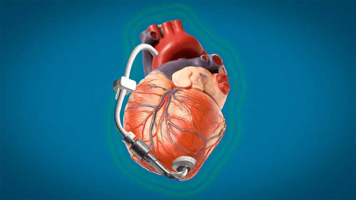 cœur muni d'une LVAD, stylisé // Source : Montage Numerama - envato & ALiEM cœur muni d'une LVAD, stylisé // Source : Montage Numerama - envato & ALiEM