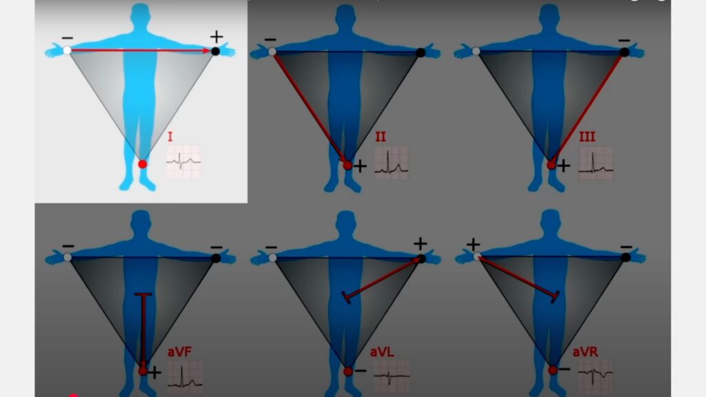 ***** // Source : Capture écran vidéo YT : "ECG Watch: How it Works (Apple, Samsung A fib Watches / EKG)" ***** // Source : Capture écran vidéo YT : "ECG Watch: How it Works (Apple, Samsung A fib Watches / EKG)"