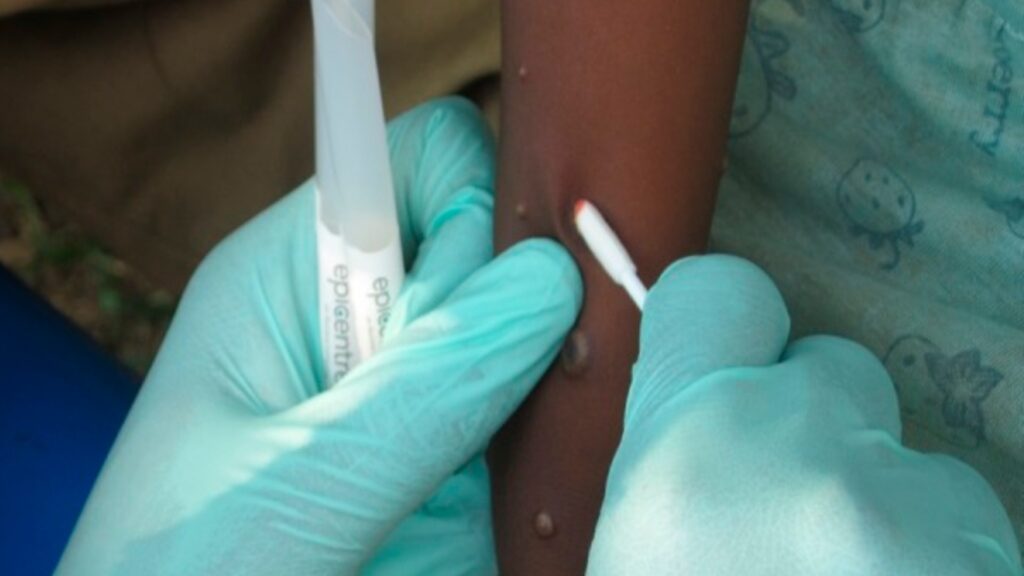 Le mpox provoque des lésions pustuleuses. // Source : A. McCollum/Wikimedias commons Le mpox provoque des lésions pustuleuses. // Source : A. McCollum/Wikimedias commons