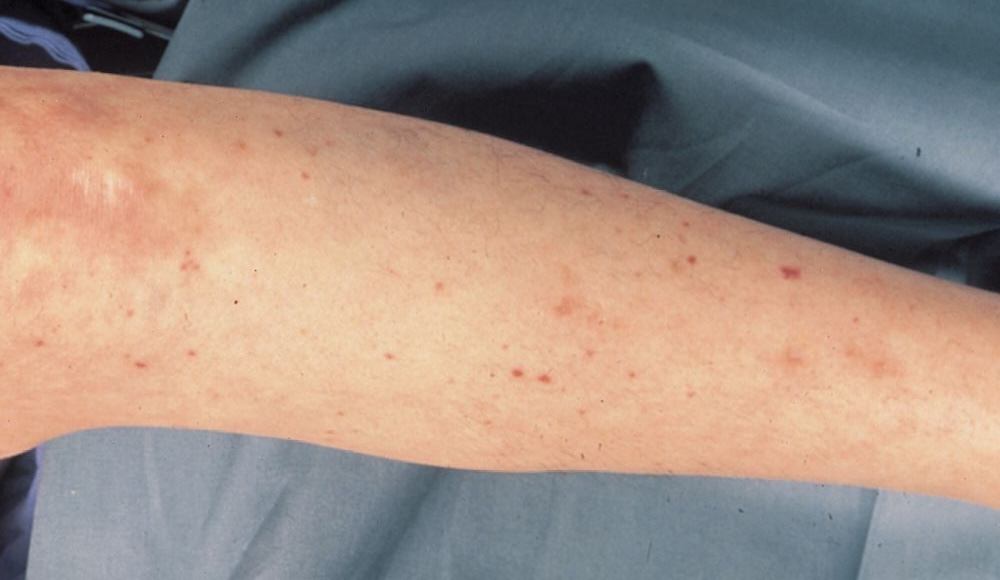 Éruption cutanée due à une infection du sang à méningocoque. // Source : Springer Science+Business Media Éruption cutanée due à une infection du sang à méningocoque. // Source : Springer Science+Business Media