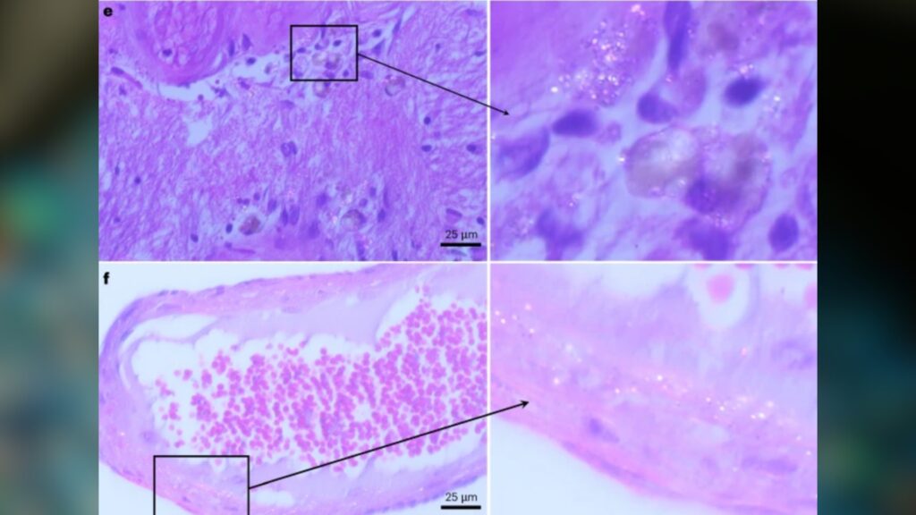 Les micro- et nano-plastiques ne sont pas visibles à l'oeil nu. Ils proviennent de la dégradation de morceaux plus gros de plastique, avant de s'éparpiller dans la nature et les tissus organiques. // Source : Nature Medecine, Nihart et al, 2025 Les micro- et nano-plastiques ne sont pas visibles à l'oeil nu. Ils proviennent de la dégradation de morceaux plus gros de plastique, avant de s'éparpiller dans la nature et les tissus organiques. // Source : Nature Medecine, Nihart et al, 2025