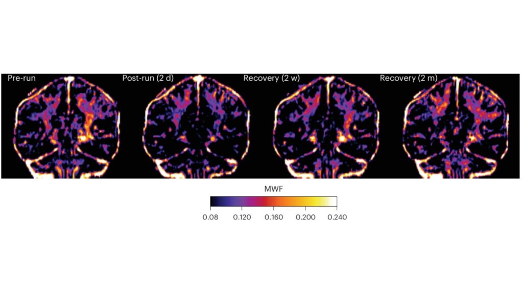 Volume de myéline dans le cerveau avant le marathon, deux jours après la course, 2 d) et deux semaines après la course, 2 w), après deux mois (2 m) de récupération // Source : Ramos-Cabrer, P., Cabrera-Zubizarreta, A., Padro, D. et al. Reversible reduction in brain myelin content upon marathon running. Nat Metab (2025). Volume de myéline dans le cerveau avant le marathon, deux jours après la course, 2 d) et deux semaines après la course, 2 w), après deux mois (2 m) de récupération // Source : Ramos-Cabrer, P., Cabrera-Zubizarreta, A., Padro, D. et al. Reversible reduction in brain myelin content upon marathon running. Nat Metab (2025).