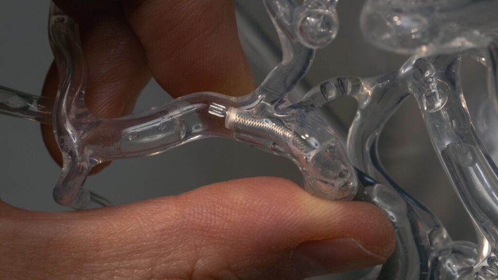 Gros plan sur le Milli-Spinner, un long tube creux rotatif rapide doté d'ailettes et de fentes près du caillot, créant une aspiration localisée. Grâce à sa conception innovante, le Milli-Spinner peut réduire les caillots sanguins sans les rompre. | // Source : Andrew Brodhead Gros plan sur le Milli-Spinner, un long tube creux rotatif rapide doté d'ailettes et de fentes près du caillot, créant une aspiration localisée. Grâce à sa conception innovante, le Milli-Spinner peut réduire les caillots sanguins sans les rompre. | // Source : Andrew Brodhead