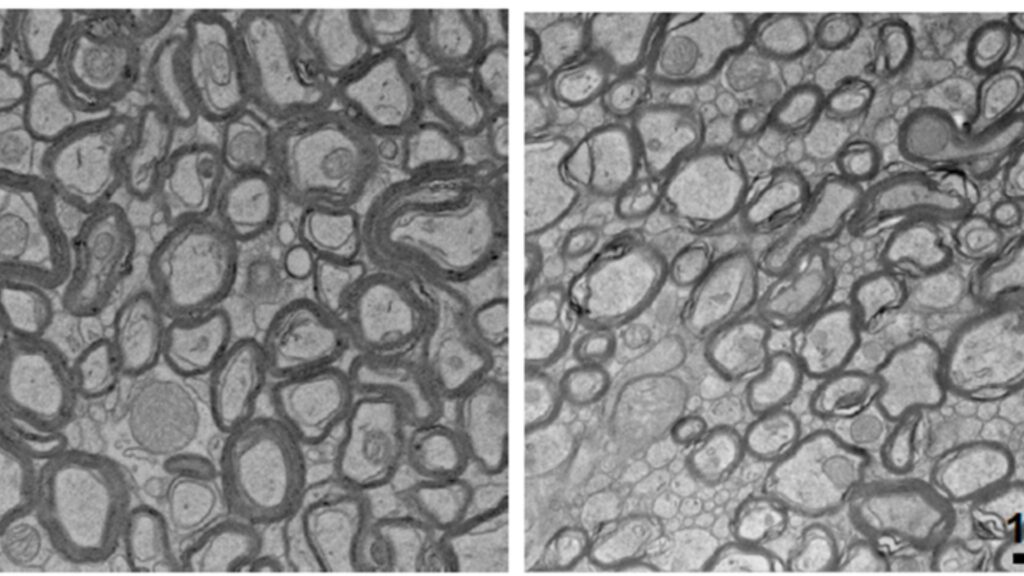 La carence en lithium a aminci la myéline qui recouvre les neurones (à droite) par rapport aux souris normales (à gauche). // Source : Laboratoire Yankner La carence en lithium a aminci la myéline qui recouvre les neurones (à droite) par rapport aux souris normales (à gauche). // Source : Laboratoire Yankner