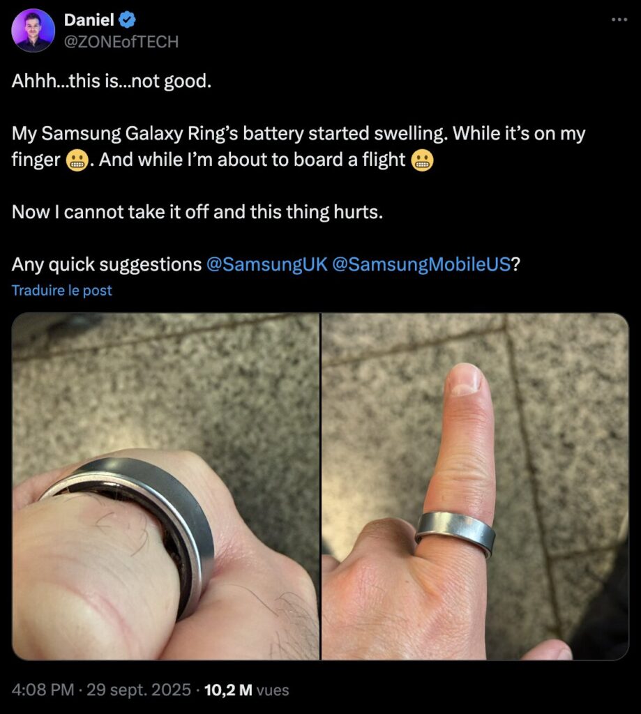Le revêtement interne de la bague a gonflé au point de serrer le doigt de Daniel. Impossible pour lui de la retirer, avec un doigt de plus en plus rouge.