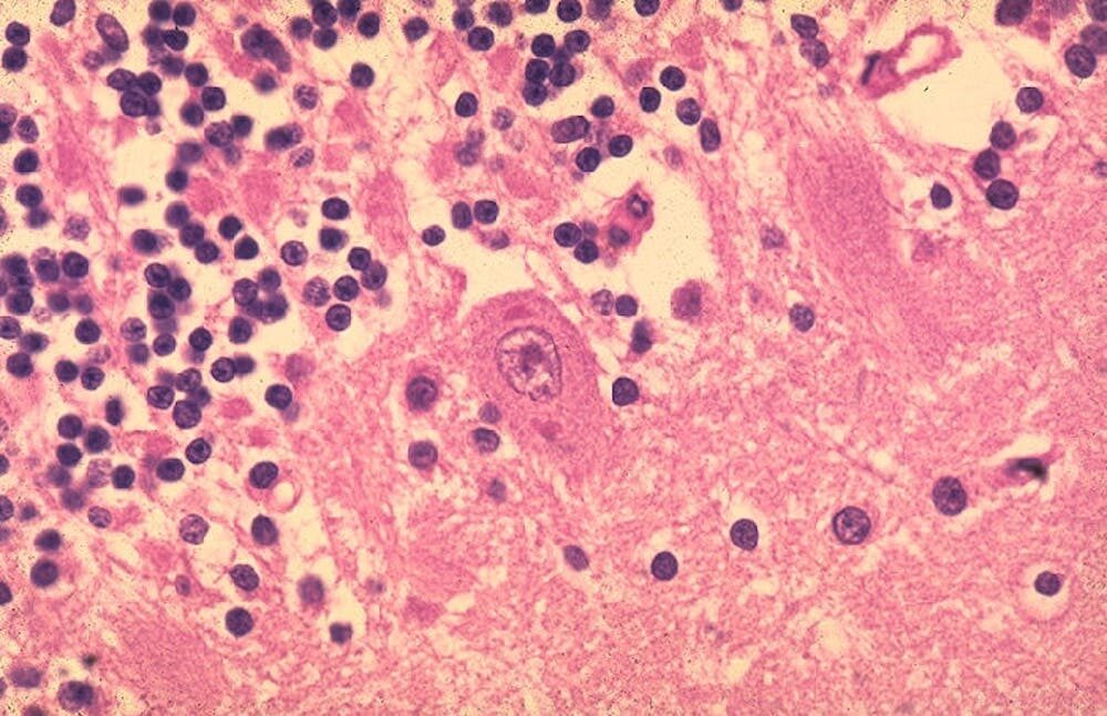 Le virus affecte le cerveau, comme on le voit avec les inclusions violettes plus foncées, appelées corps de Negri, dans les cellules cérébrales d’une personne morte de la rage. // Source :  CDC/Dr. Makonnen Fekadu